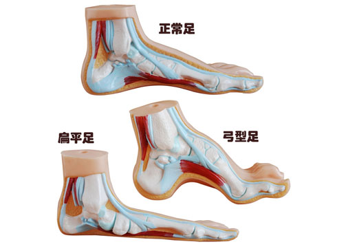 正常足、扁平足、弓形足